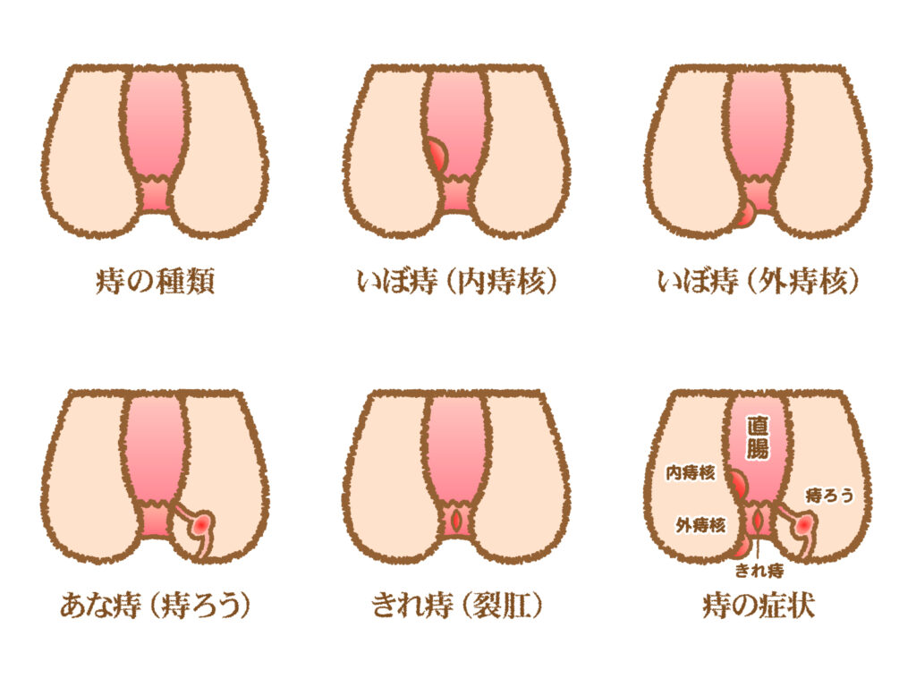 痔の種類のイメージとして